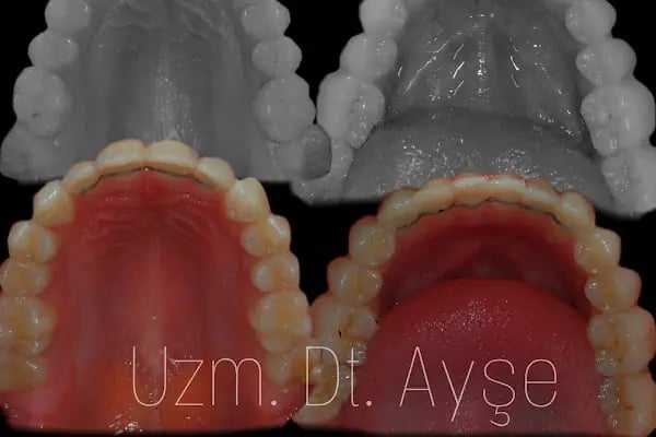 Uzm. Dt. Ayşe Menzek Yıldırım Ortodonti Kliniği, Konya Ortodonti Uzmanı, Şeffaf Plak Tedavisi, Diş Teli Uygulaması - Resim 15