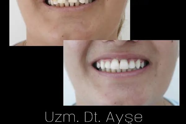 Uzm. Dt. Ayşe Menzek Yıldırım Ortodonti Kliniği, Konya Ortodonti Uzmanı, Şeffaf Plak Tedavisi, Diş Teli Uygulaması - Resim 18