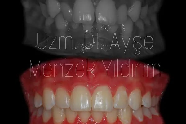 Uzm. Dt. Ayşe Menzek Yıldırım Ortodonti Kliniği, Konya Ortodonti Uzmanı, Şeffaf Plak Tedavisi, Diş Teli Uygulaması - Resim 13