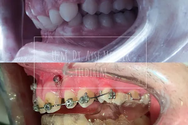 Uzm. Dt. Ayşe Menzek Yıldırım Ortodonti Kliniği, Konya Ortodonti Uzmanı, Şeffaf Plak Tedavisi, Diş Teli Uygulaması - Resim 3