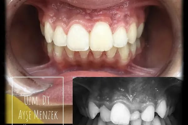 Uzm. Dt. Ayşe Menzek Yıldırım Ortodonti Kliniği, Konya Ortodonti Uzmanı, Şeffaf Plak Tedavisi, Diş Teli Uygulaması - Resim 14