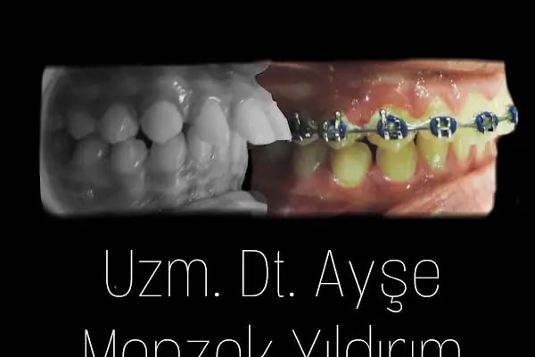 Uzm. Dt. Ayşe Menzek Yıldırım Ortodonti Kliniği, Konya Ortodonti Uzmanı, Şeffaf Plak Tedavisi, Diş Teli Uygulaması - Resim 12