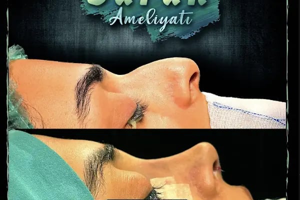 Op. Dr. Çağatay Falcıoğlu I Ankara Rinoplasti I Estetik Cerrahi I Meme Büyütme - Dikleştirme - Küçültme I Liposuction - Resim 9