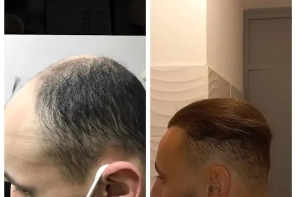 BELLA HAIR - Greffe de Cheveux- DHI-FUE - Resim 15