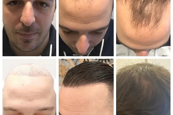 BELLA HAIR - Greffe de Cheveux- DHI-FUE - Resim 11