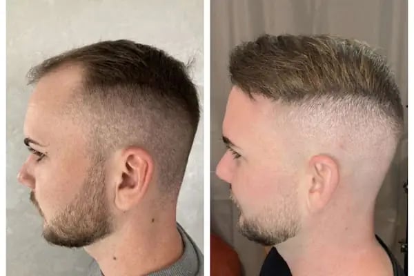 BELLA HAIR - Greffe de Cheveux- DHI-FUE - Resim 19