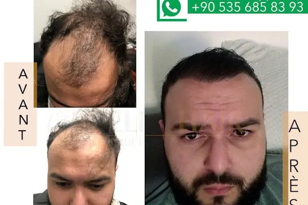 BELLA HAIR - Greffe de Cheveux- DHI-FUE - Resim 14