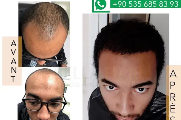 BELLA HAIR - Greffe de Cheveux- DHI-FUE - Resim 13