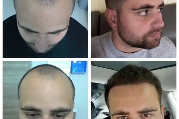 BELLA HAIR - Greffe de Cheveux- DHI-FUE - Resim 12
