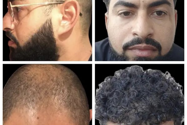 BELLA HAIR - Greffe de Cheveux- DHI-FUE - Resim 10