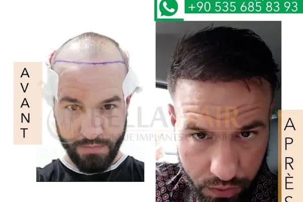 BELLA HAIR - Greffe de Cheveux- DHI-FUE - Resim 20