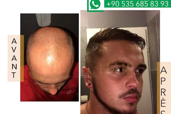 BELLA HAIR - Greffe de Cheveux- DHI-FUE - Resim 17