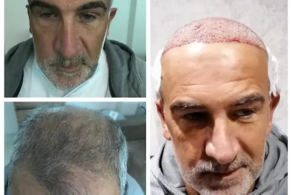BELLA HAIR - Greffe de Cheveux- DHI-FUE - Resim 9