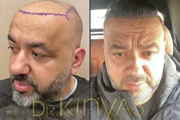 drkinyashairclinic - Resim 12