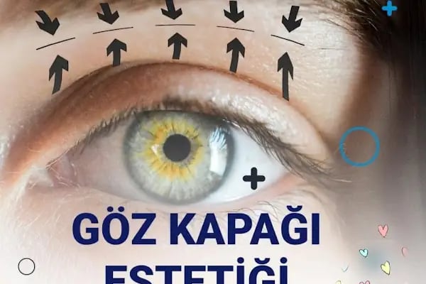 Ankara Hastane Göz Kapağı Estetiği ,Saç Ekimi , Sağlık Danışmanlık - Resim 6