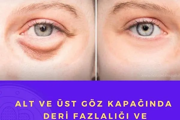 Ankara Hastane Göz Kapağı Estetiği ,Saç Ekimi , Sağlık Danışmanlık - Resim 14