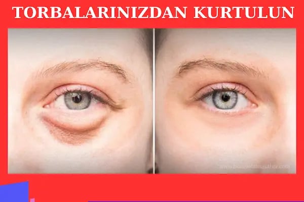 Ankara Hastane Göz Kapağı Estetiği ,Saç Ekimi , Sağlık Danışmanlık - Resim 13