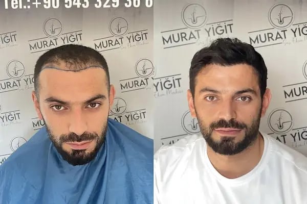 Gaziantep Saç Ekimi - Murat Yiğit - Resim 2