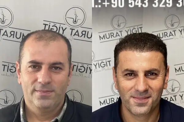 Gaziantep Saç Ekimi - Murat Yiğit - Resim 4