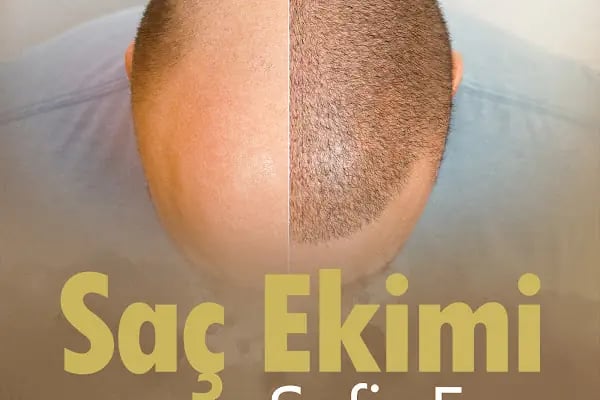 Fuse Saç Ekimi - Resim 6
