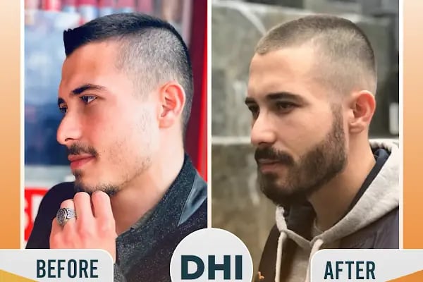 Regardhair Saç Ekim - Resim 10