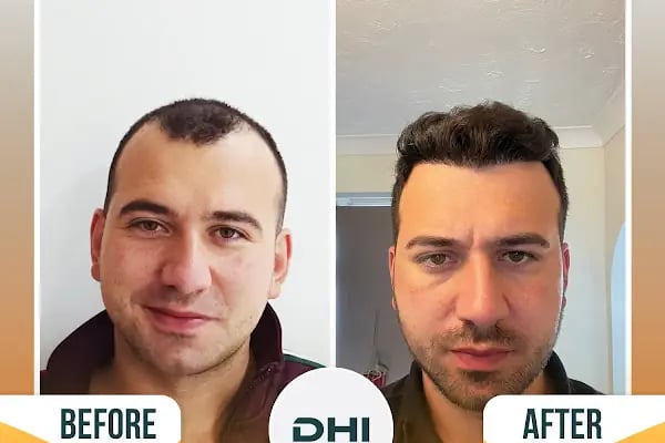 Regardhair Saç Ekim - Resim 16