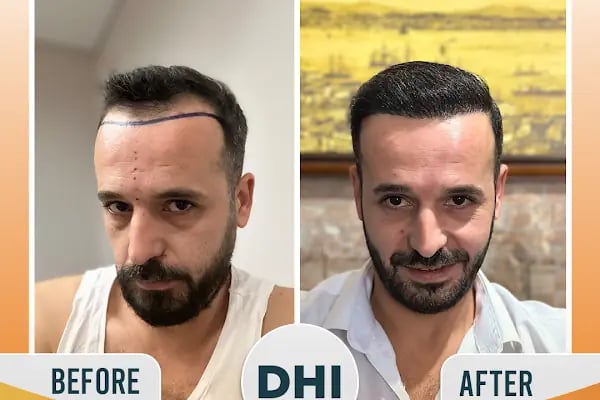 Regardhair Saç Ekim - Resim 12