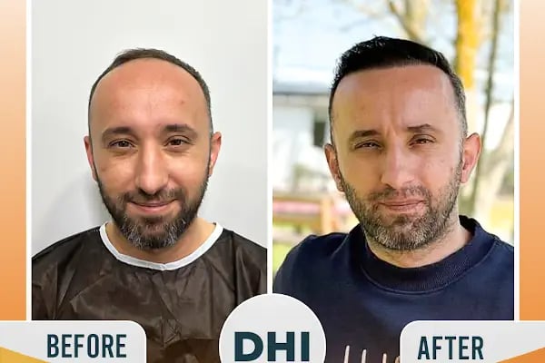 Regardhair Saç Ekim - Resim 11