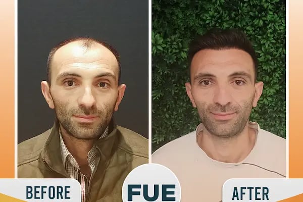 Regardhair Saç Ekim - Resim 13