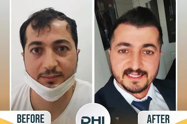Regardhair Saç Ekim - Resim 17