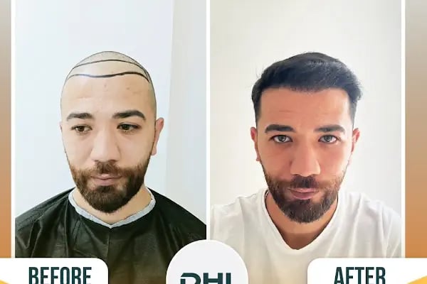 Regardhair Saç Ekim - Resim 18