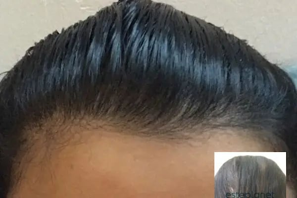 Esteplanet Hair Center - Resim 11