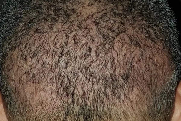 Serkan Aydin Hair Transplant - Resim 1