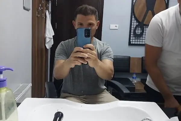 Serkan Aydin Hair Transplant - Resim 8