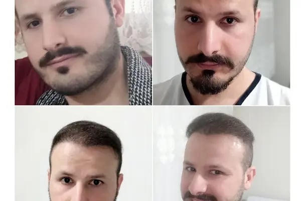 Serkan Aydin Hair Transplant - Resim 20