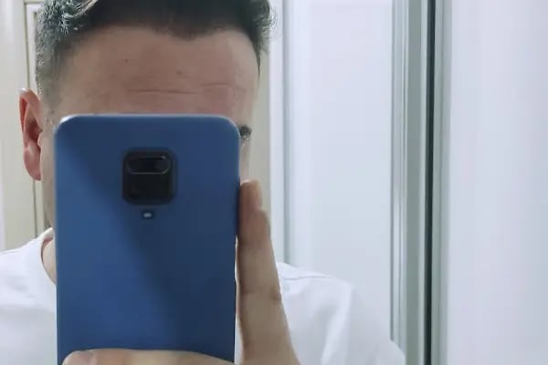 Serkan Aydin Hair Transplant - Resim 16