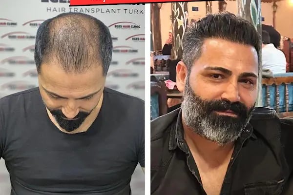 Balıkesir Saç Ekim Merkezi - Resim 18