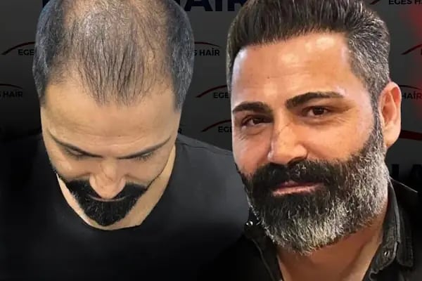 Balıkesir Saç Ekim Merkezi - Resim 11