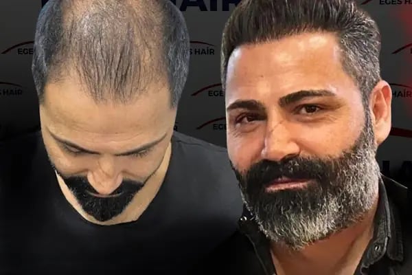 Balıkesir Saç Ekim Merkezi - Resim 14