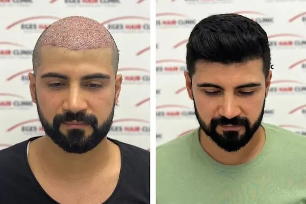 Balıkesir Saç Ekim Merkezi - Resim 3