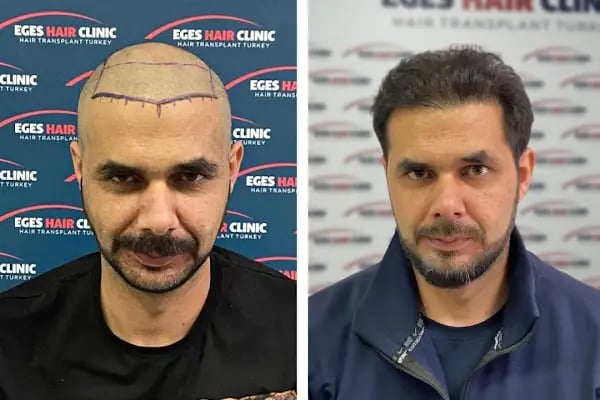 Balıkesir Saç Ekim Merkezi - Resim 10