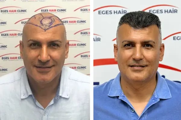 Balıkesir Saç Ekim Merkezi - Resim 19