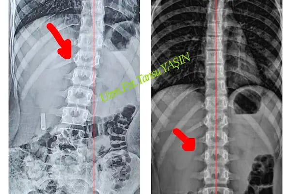 Uzman Fizyoterapist Tansu YAŞİN Fizyoterapi ve Skolyoz Merkezi - Resim 5