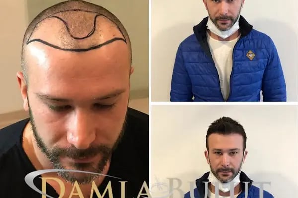 Damlabuluthairtrans Saç Ekim Kliniği - Resim 1