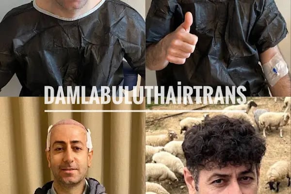 Damlabuluthairtrans Saç Ekim Kliniği - Resim 8