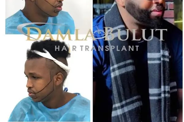 Damlabuluthairtrans Saç Ekim Kliniği - Resim 18