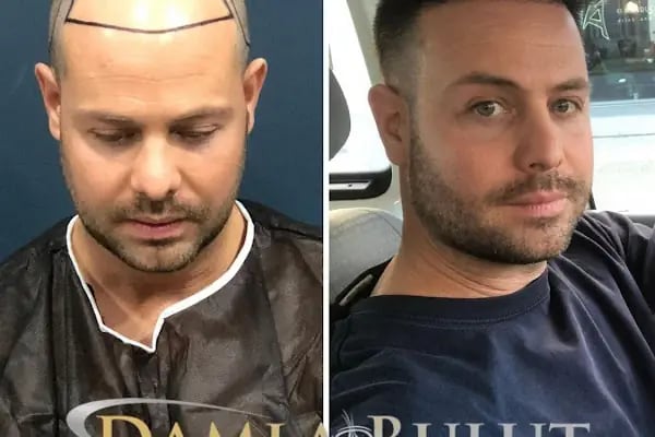 Damlabuluthairtrans Saç Ekim Kliniği - Resim 11
