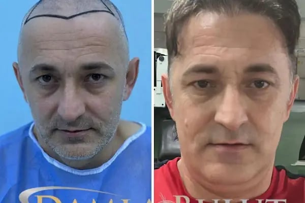 Damlabuluthairtrans Saç Ekim Kliniği - Resim 15