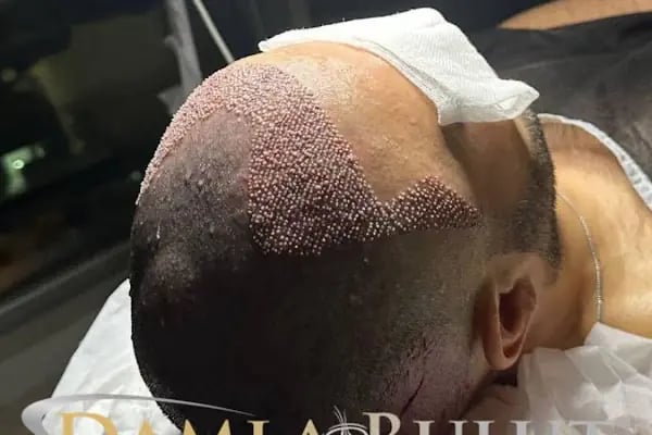 Damlabuluthairtrans Saç Ekim Kliniği - Resim 9