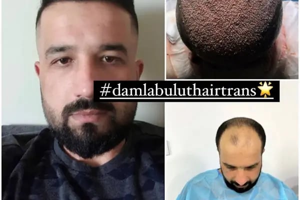 Damlabuluthairtrans Saç Ekim Kliniği - Resim 17